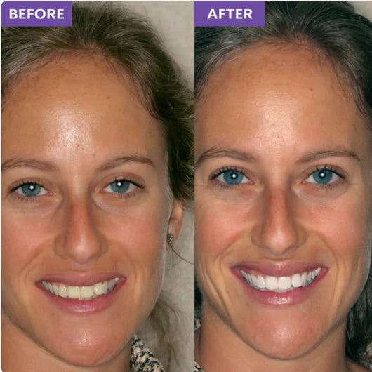 SMILEO™ - Whitening Strips