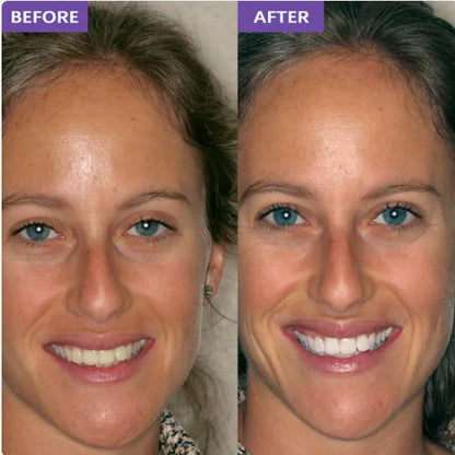 SMILEO™ - Whitening Strips