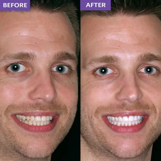 SMILEO™ - Whitening Strips