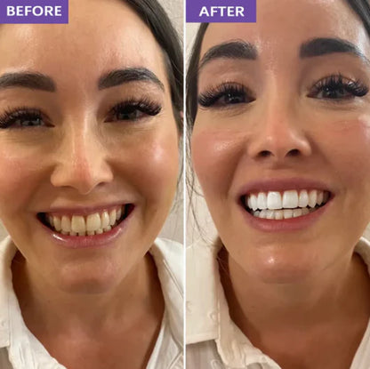 SMILEO™ - Whitening Strips